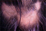 bald patches