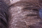 Flaky Itchy Scalp Flaky Itchy Scalp