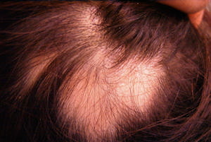 Alopecia Areata Treatments - Bald Patches Treatment - Hairology - 'The Root to Healthier Hair'.