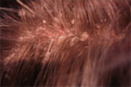 Large White Patch On Scalp
