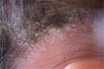 psoriasis
