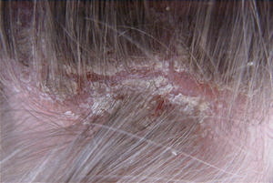 Scalp Psoriasis - Sebhorreic Dermatitis Treatment - Hairology - 'The Root to Healthier Hair'.