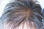 hair loss/thinning hair photo