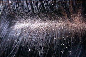 Scalp Dandruff photo