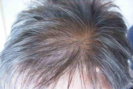 Hair Loss in Women, Thinning Hair in Women, Hair Loss in Women, Hair Thinning Women - photo.